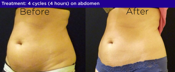 coolsculpting before and after chester springs pa Bella Medspa