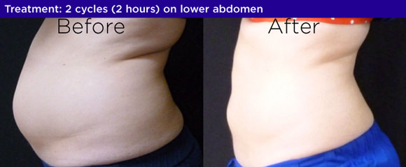 coolsculpting before and after bucks county pa Bella Medspa