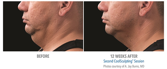 double chin coolsculpting before and after men