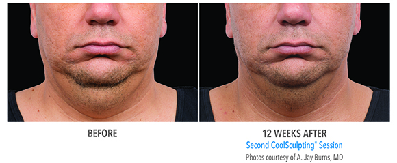 men double chin coolsculpting before and after