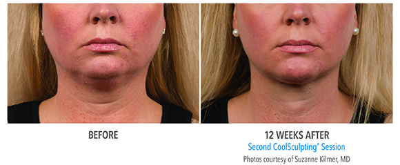 double chin coolsculpting before and after