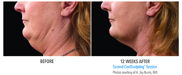 double chin coolsculpting before and after for woman