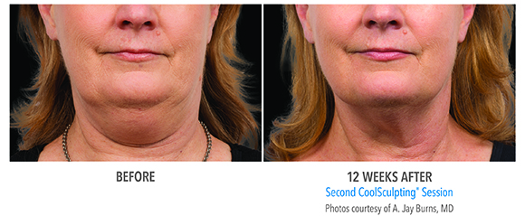 woman double chin coolsculpting before and after